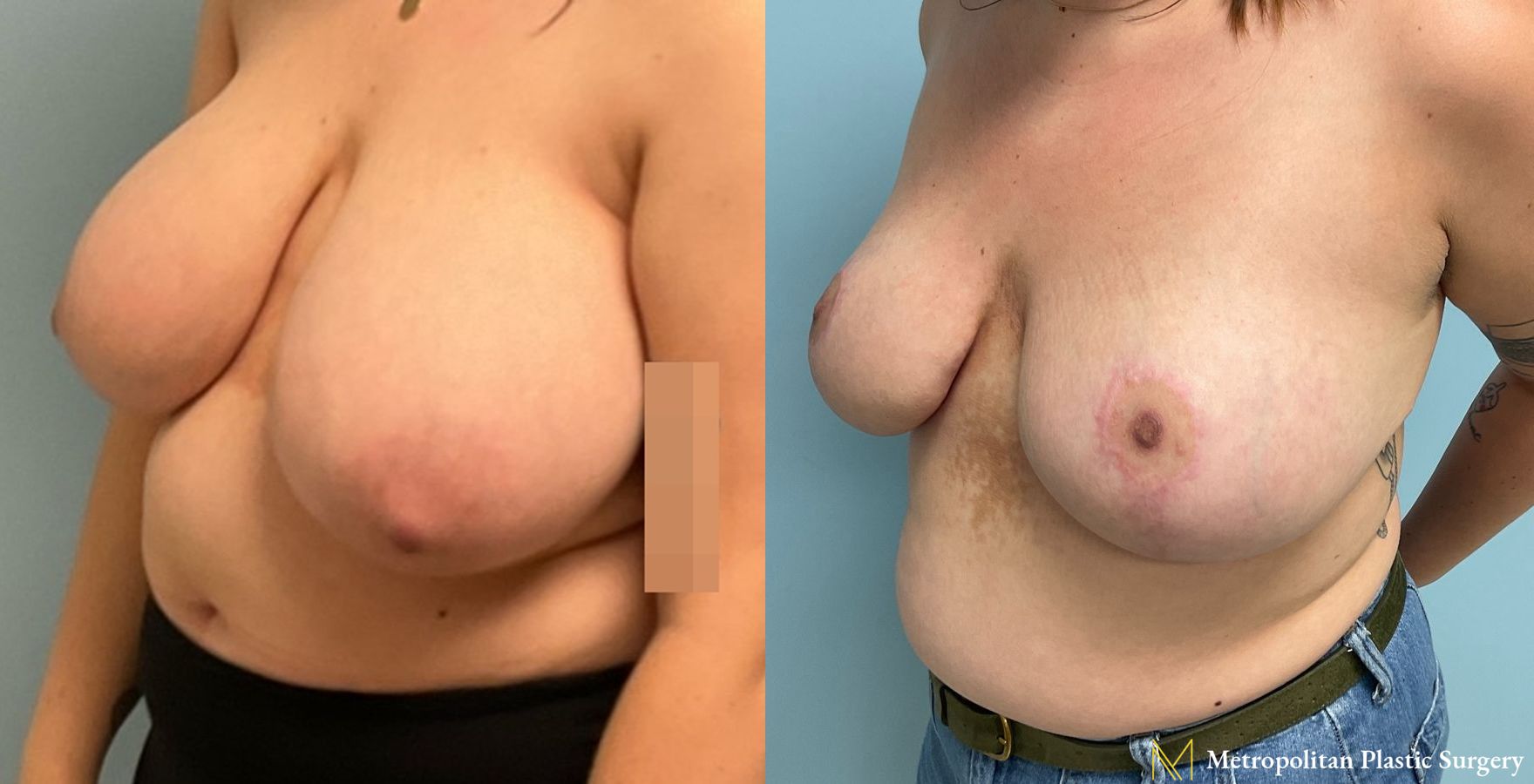 Before and after breast reduction surgery by Julia Spears MD - Angle 5