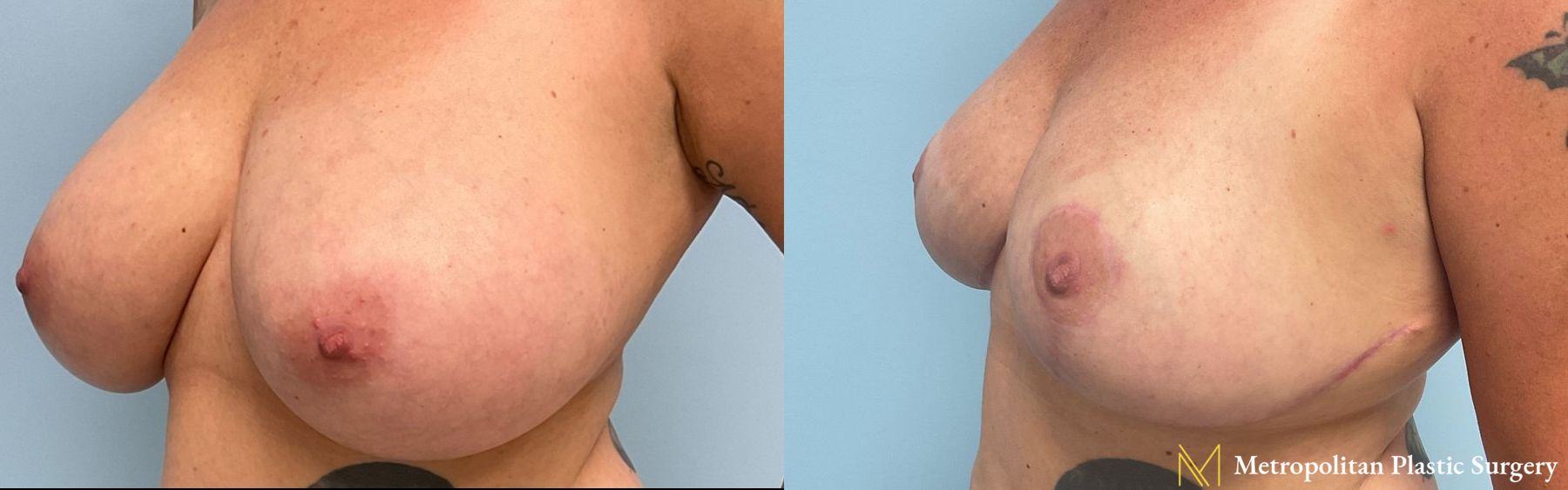 Before and after breast reduction surgery by Julia Spears MD - Angle 3