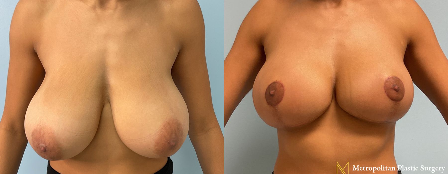 Breast Lift - Thumbnail 2