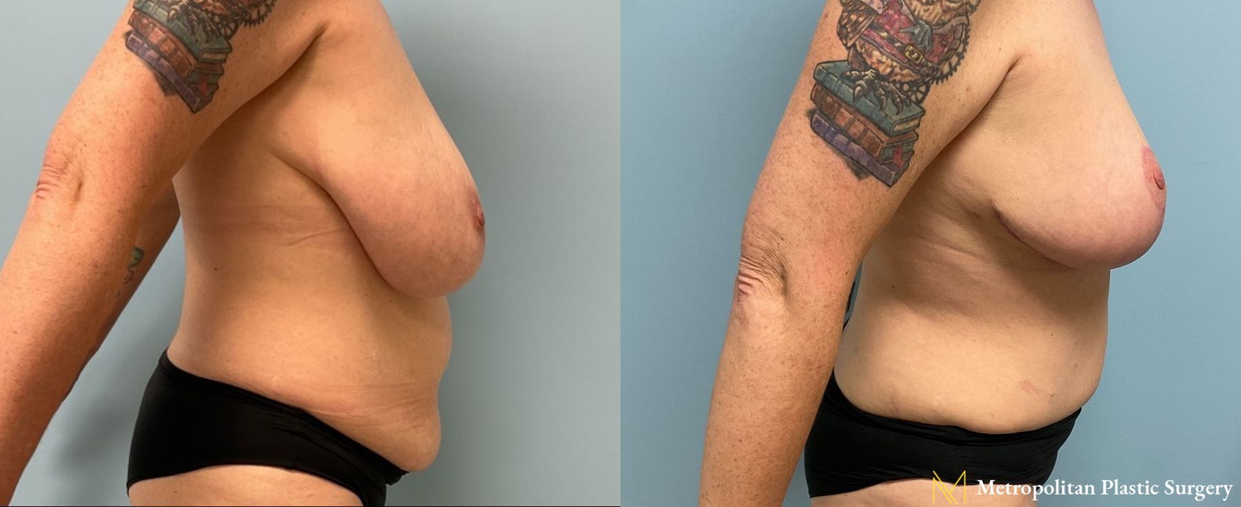 Before and after Mommy Makeover case 8098 - Angle 3