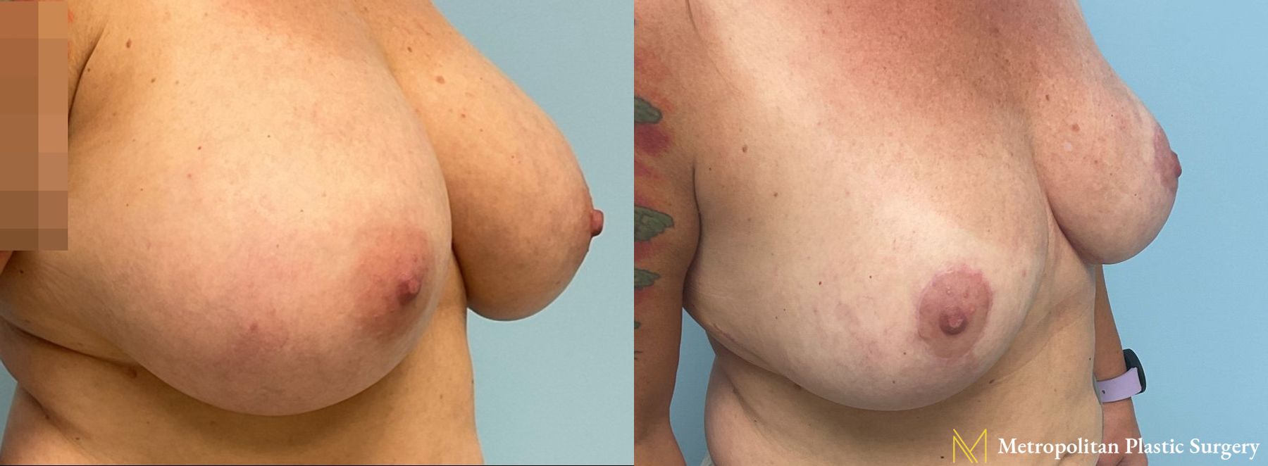 Before and after breast reduction surgery by Julia Spears MD - Angle 5