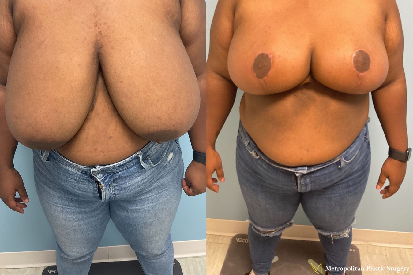 Before and after breast reduction surgery by Julia Spears MD