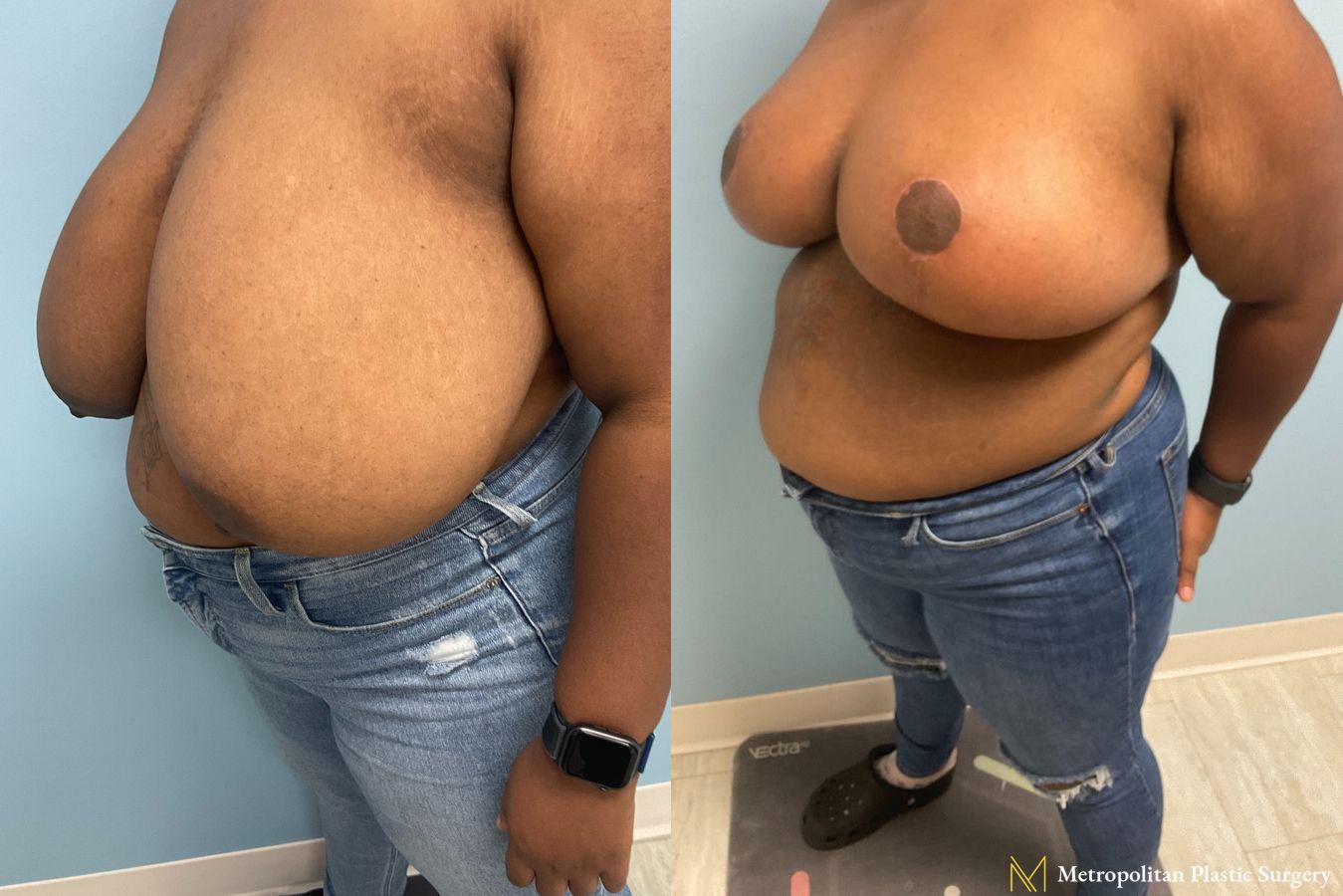 Before and after breast reduction surgery by Julia Spears MD - Angle 3