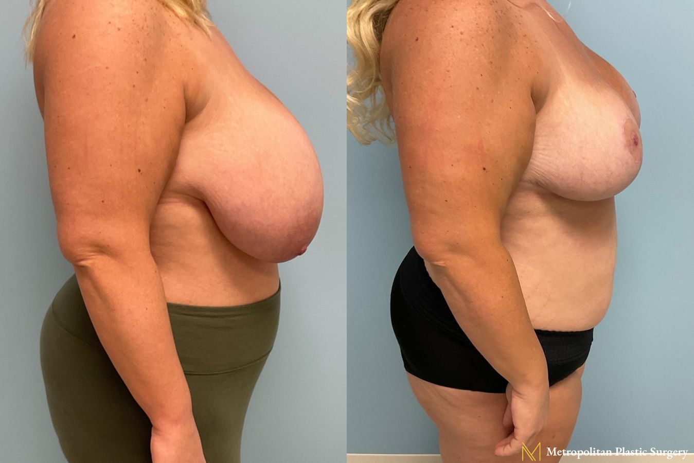 Before and after breast reduction surgery by Julia Spears MD - Angle 4