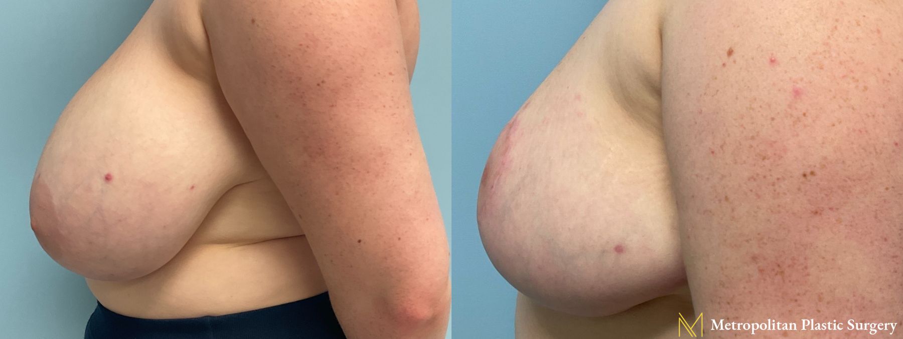 Before and after breast reduction surgery by Julia Spears MD - Angle 3