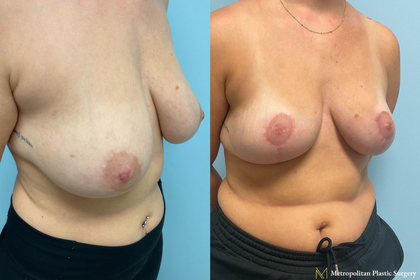Before and after photos of breast reduction surgery by Julia Spears MD - Angle 5