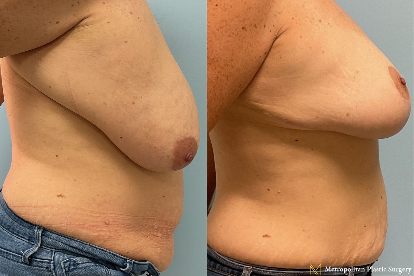 Before & After Breast Reduction (Mammaplasty) with Tummy Tuck by board certified Julia Spears MD - Angle 2