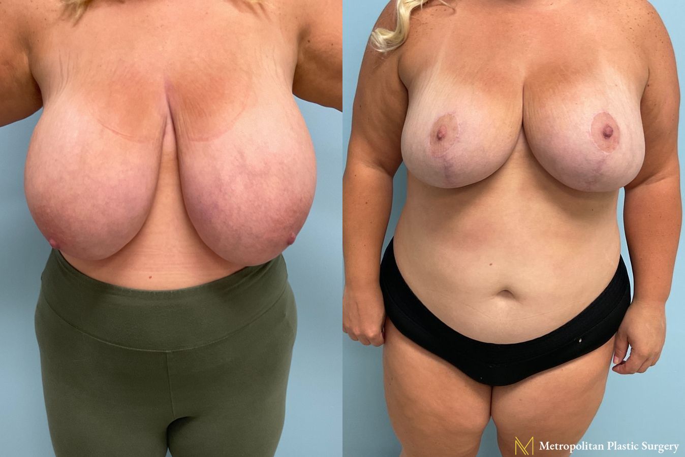 Before and after breast reduction surgery by Julia Spears MD