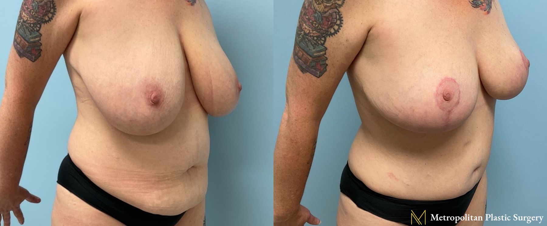 Before and after Mommy Makeover case 8098 - Angle 2