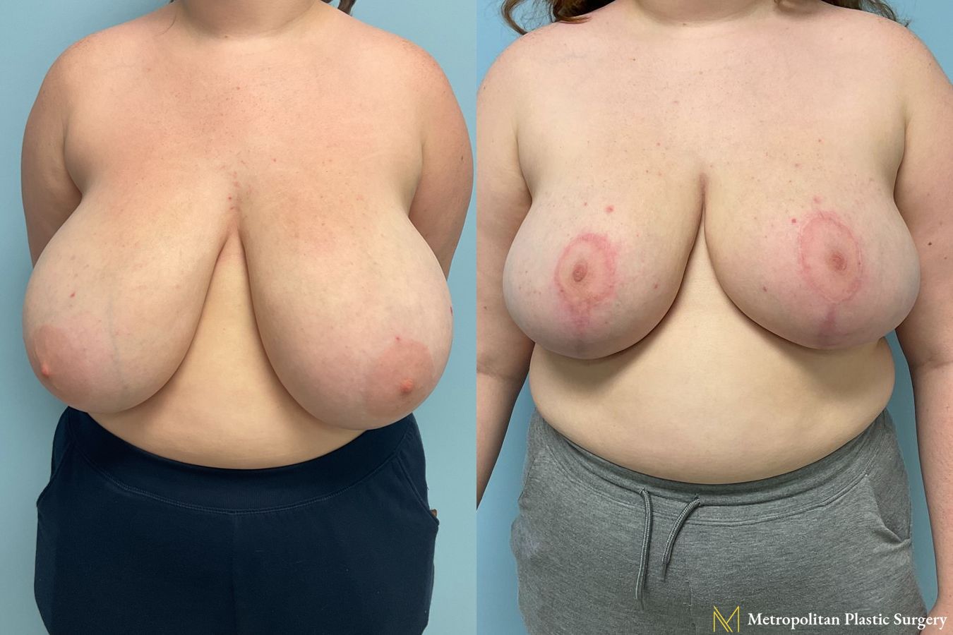 Before and after breast reduction surgery by Julia Spears MD