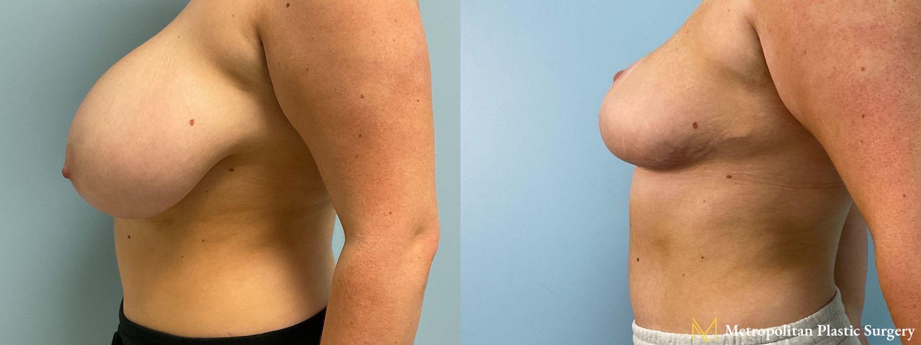 Breast Reduction performed by Dr. Julia Spears - Angle 3