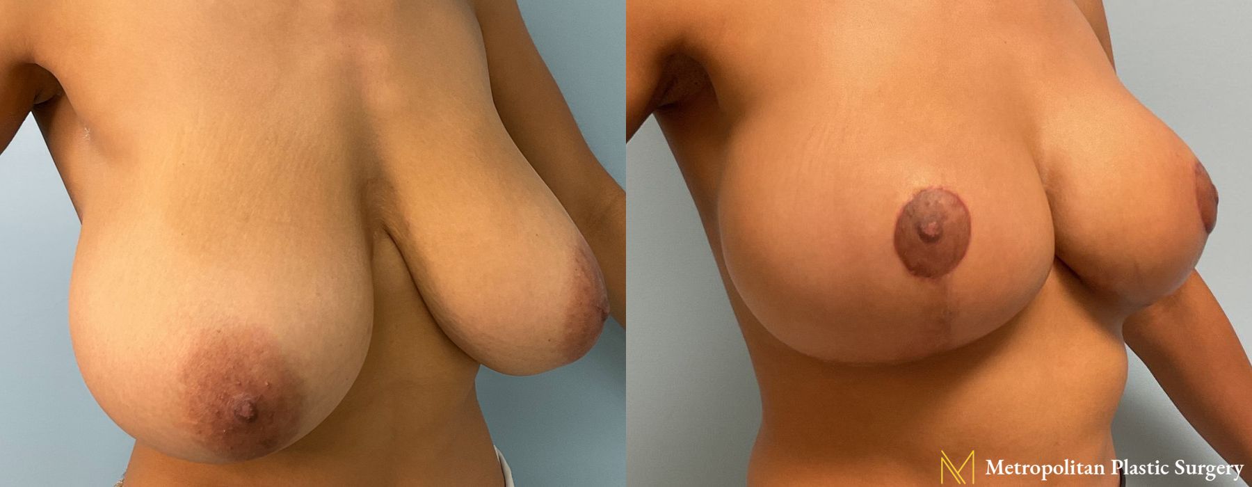 Breast Lift & Reduction Surgery Before & After Photos - Angle 2