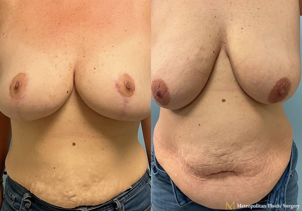 Before & After Breast Reduction (Mammaplasty) with Tummy Tuck by board certified Julia Spears MD