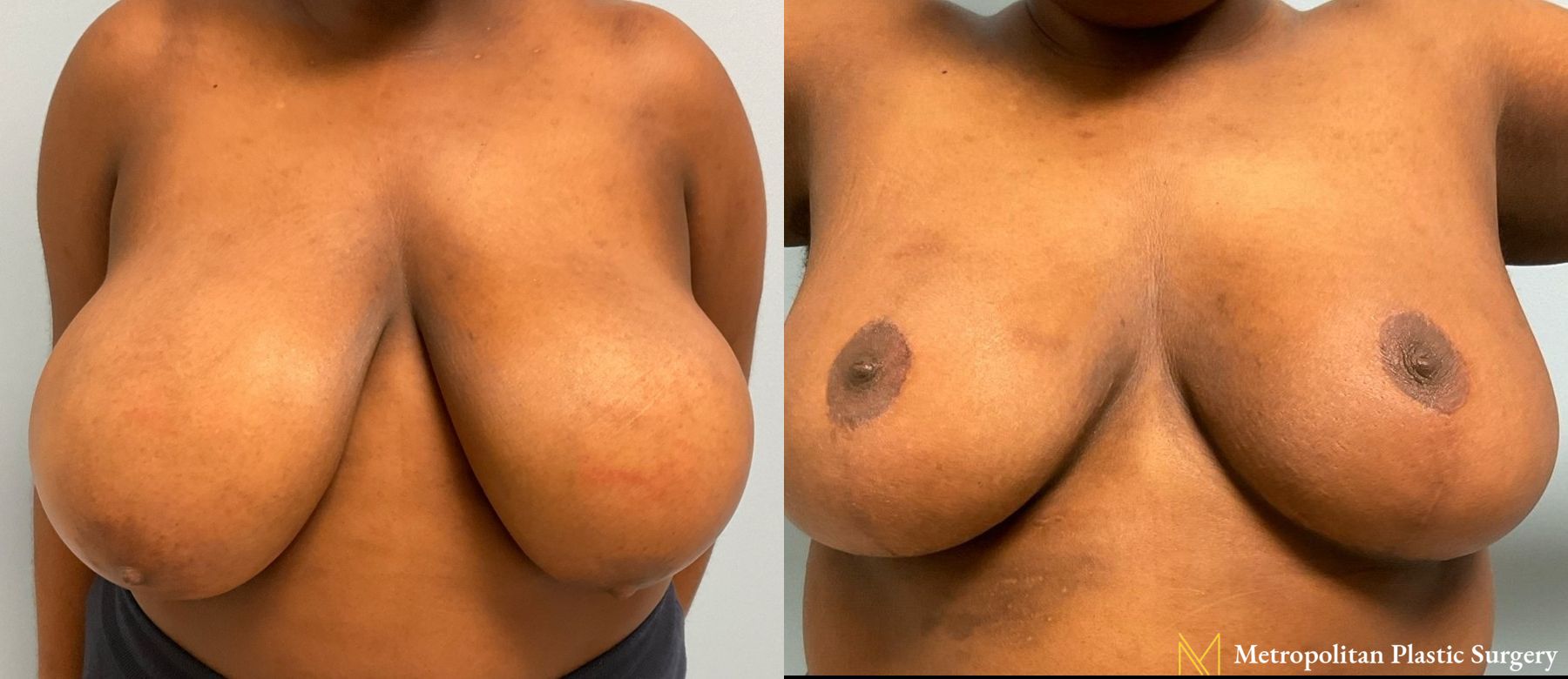 Before and after breast reduction surgery by Julia Spears MD