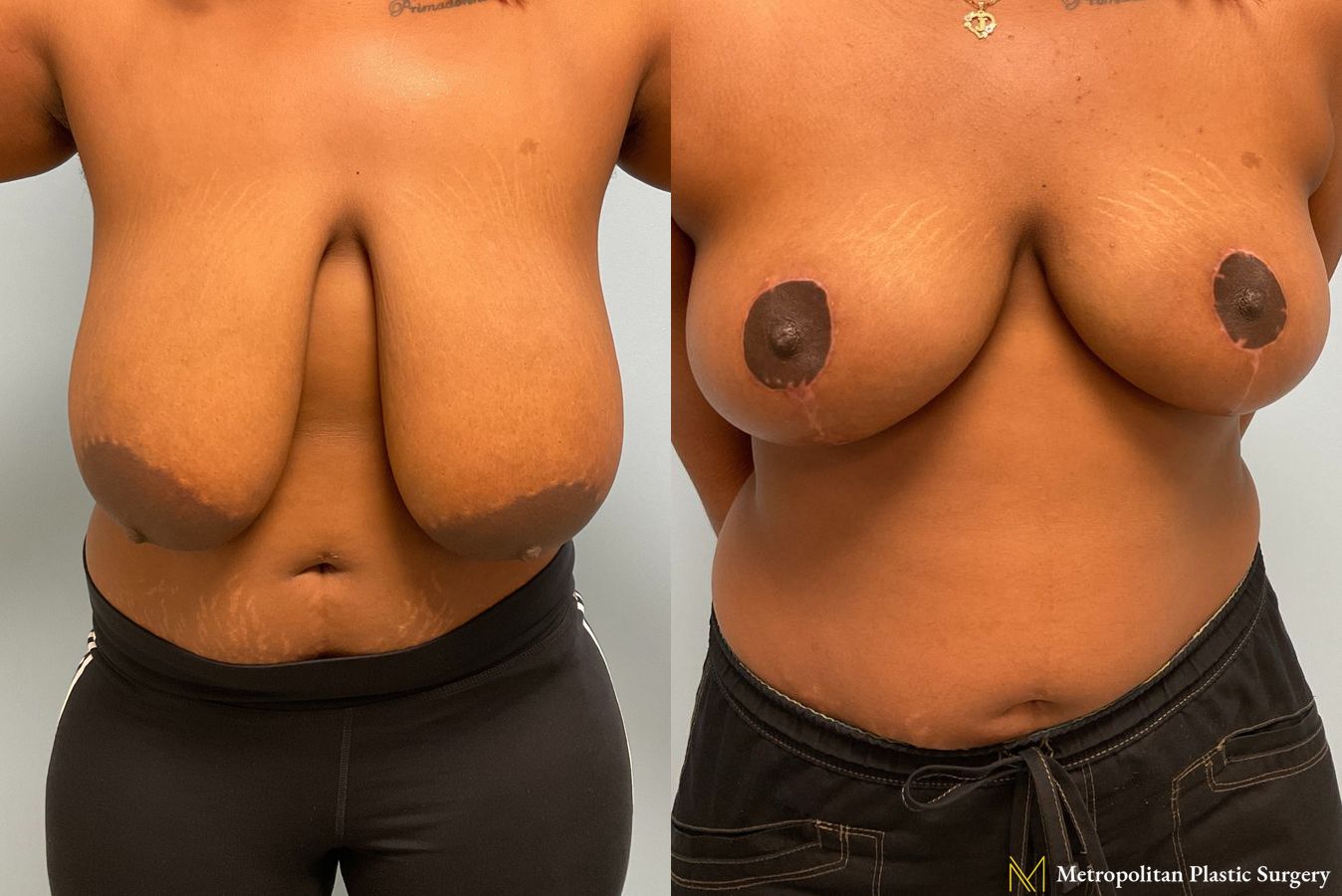 Before and after photos of breast reduction surgery by Julia Spears MD