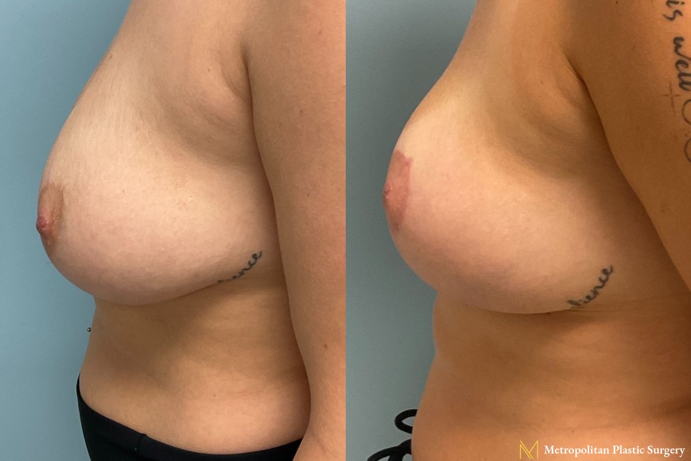 Before and after photos of breast reduction surgery by Julia Spears MD - Angle 2