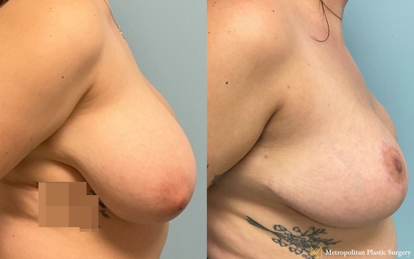 Before and after breast reduction surgery by Julia Spears MD - Angle 4