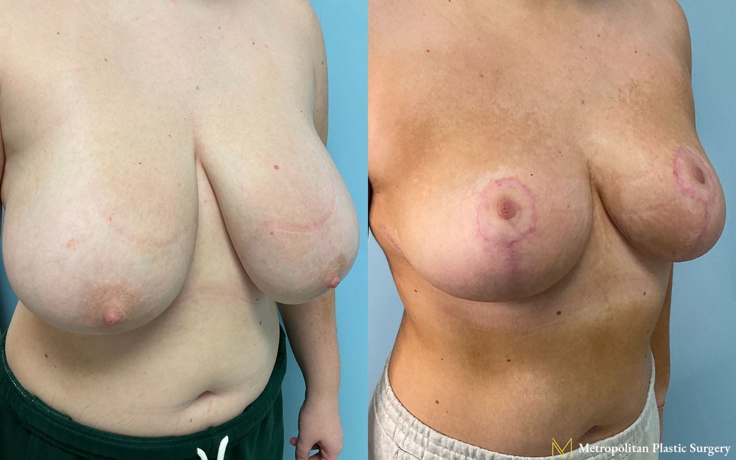 Breast Reduction performed by Dr. Julia Spears