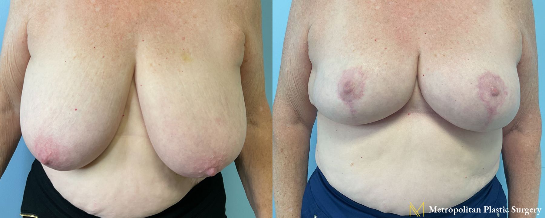 Breast Reduction performed by Dr. Julia Spears