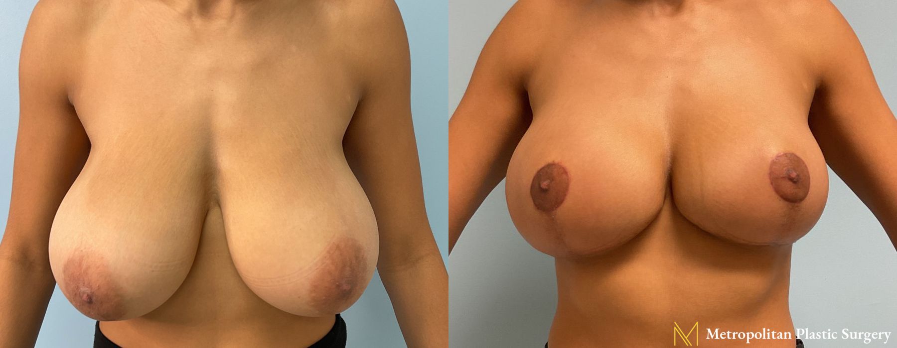 Breast Lift & Reduction Surgery Before & After Photos