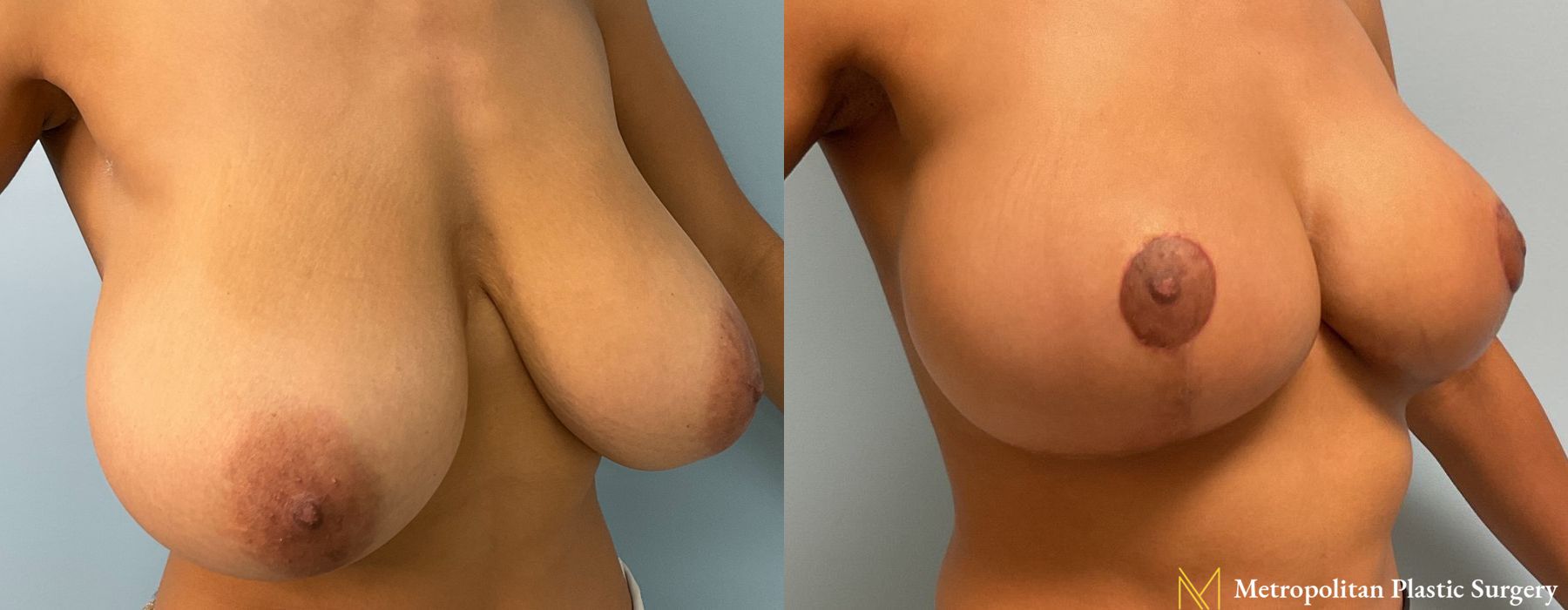 Breast Lift - Case 100
