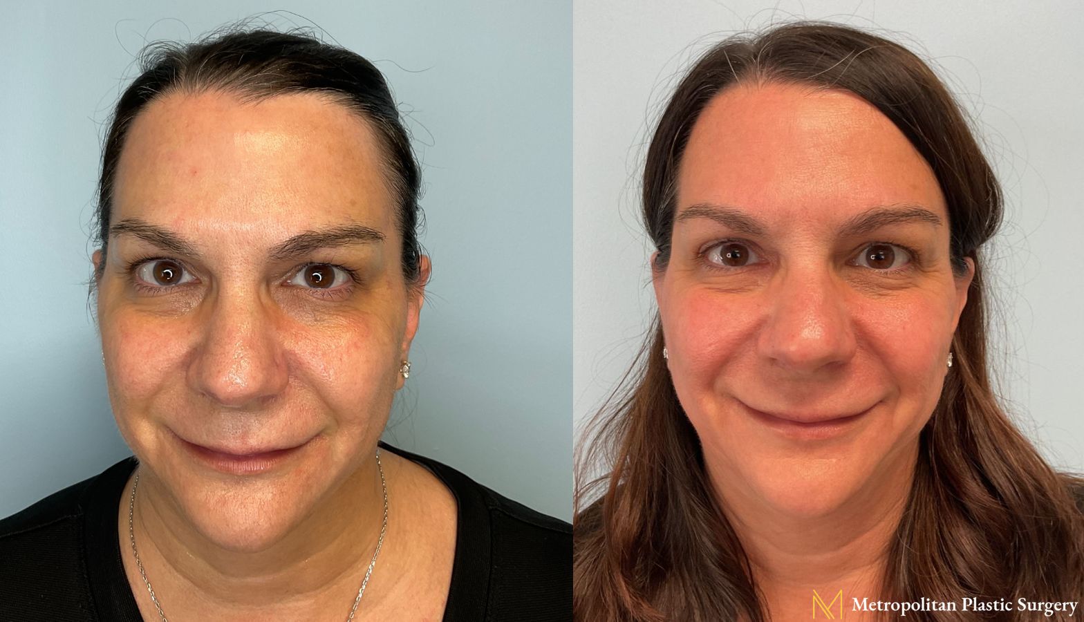 Co2 Laser Treatment performed by Dr. Julia Spears