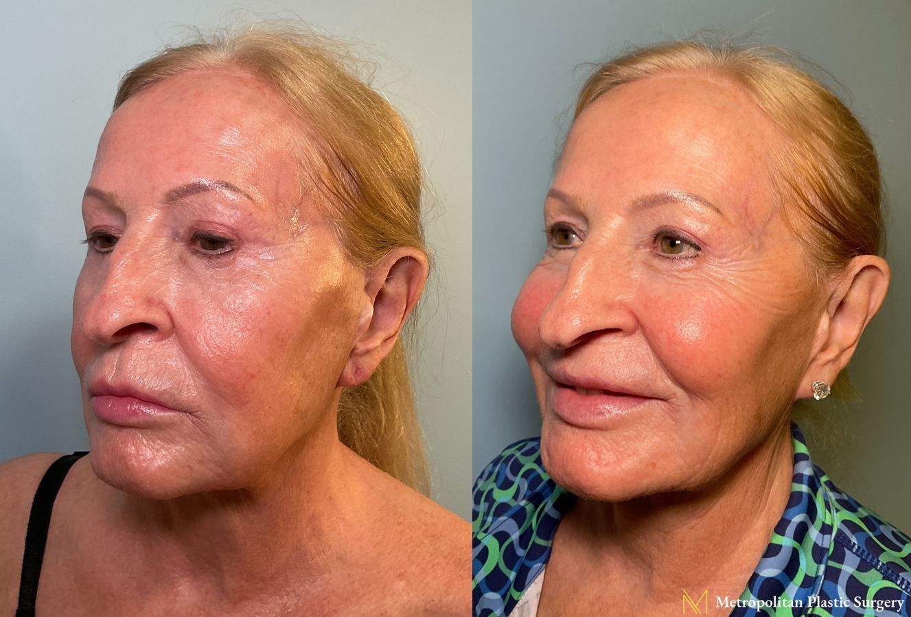 Co2 Laser Treatment for Face performed by Dr. Julia Spears at Metropolitan Plastic Surgery