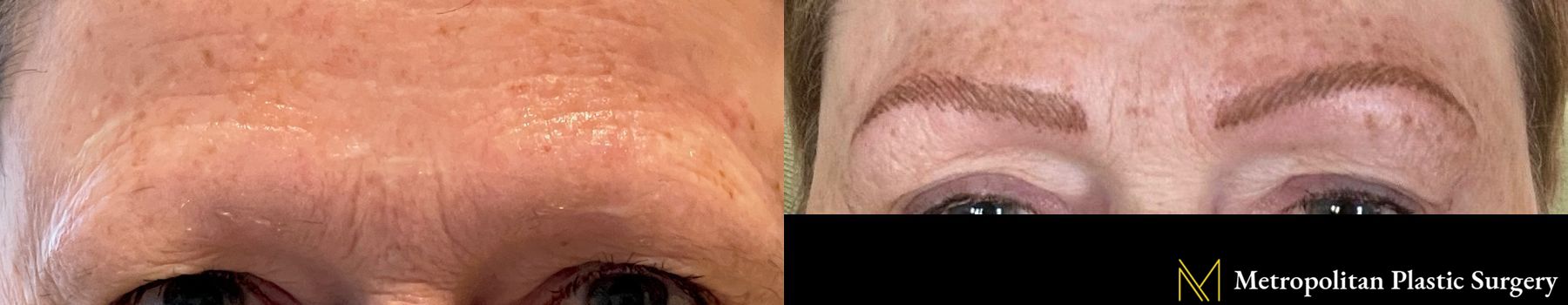 Before and after Cosmetic Tattoo case 41730