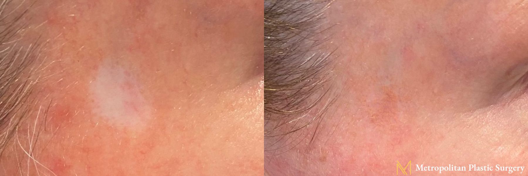 Before and after Cosmetic Tattoo case 41731