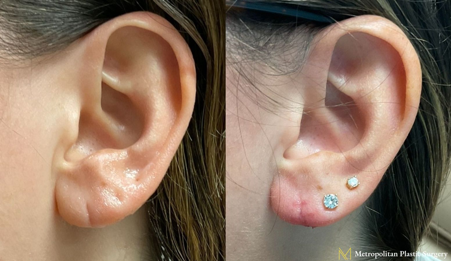 Before and after earlobe repair by Julia Spears MD