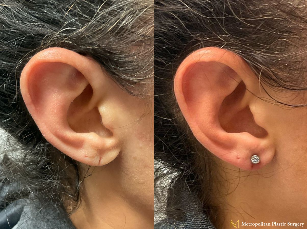 Before and after earlobe repair by Julia Spears MD