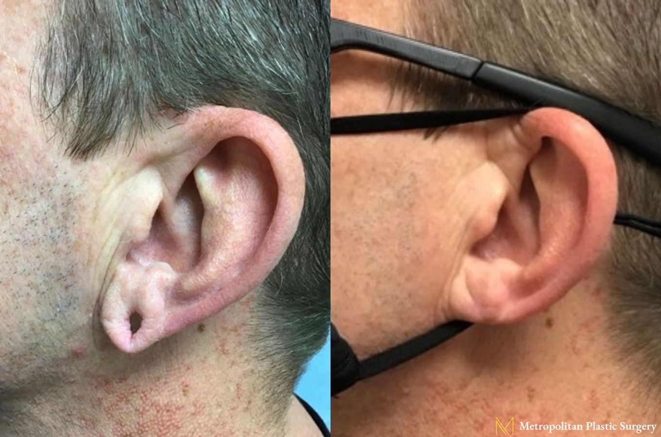 Before and after earlobe repair by Julia Spears MD - Angle 2