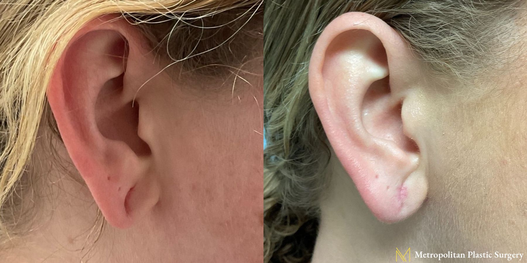 Before and after earlobe repair by Julia Spears MD