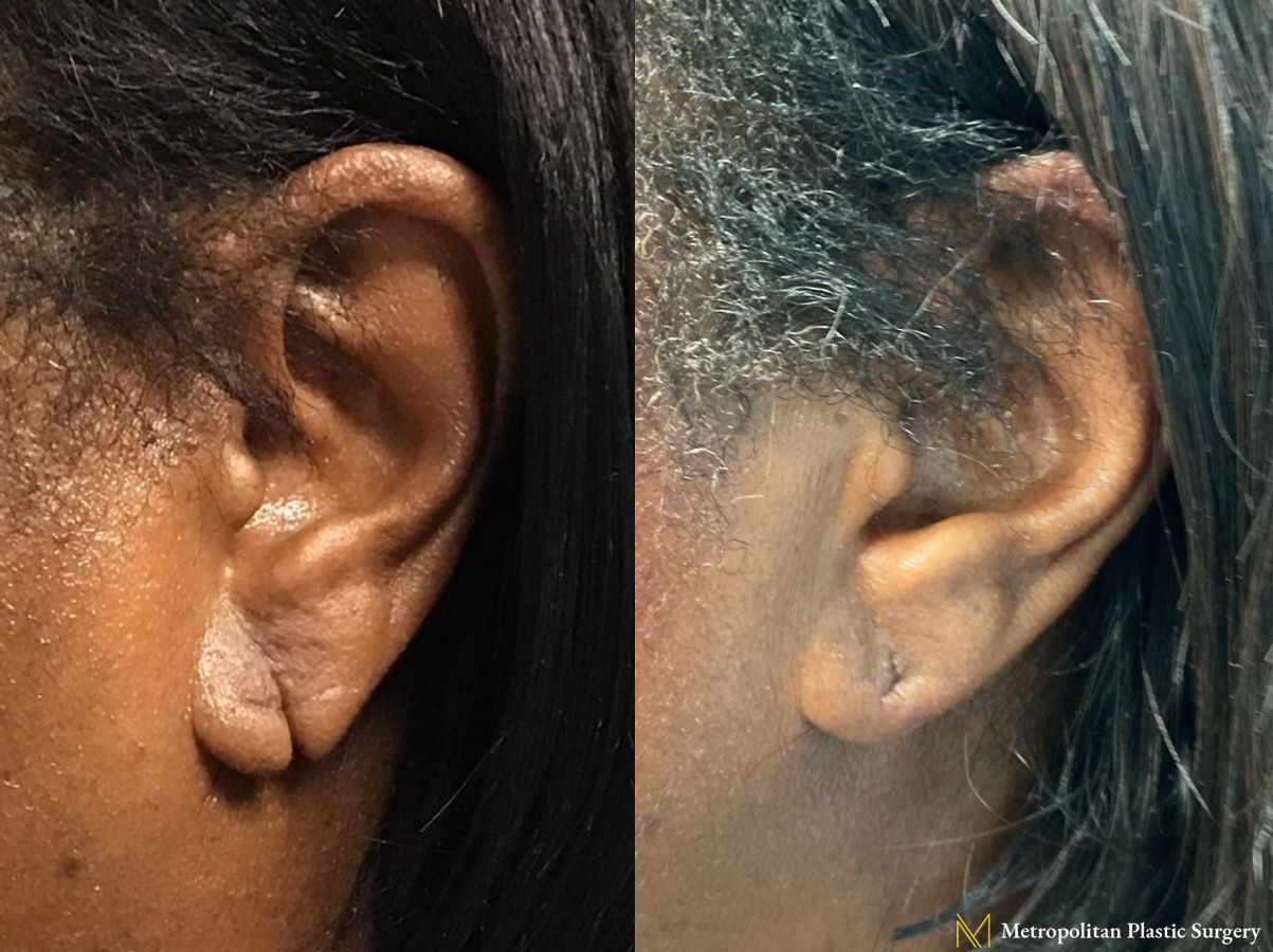 Before and after earlobe repair by Julia Spears MD