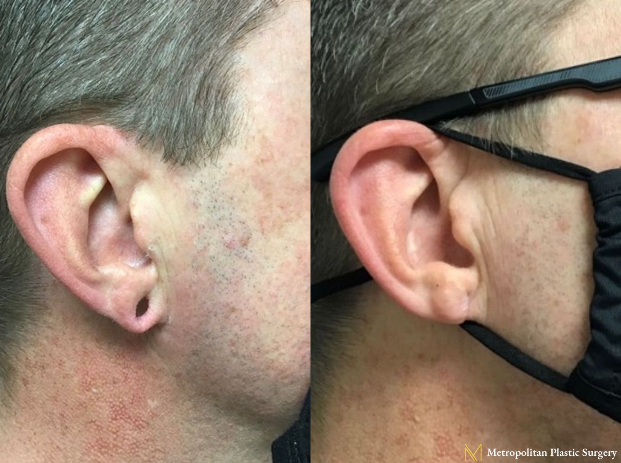 Before and after earlobe repair by Julia Spears MD
