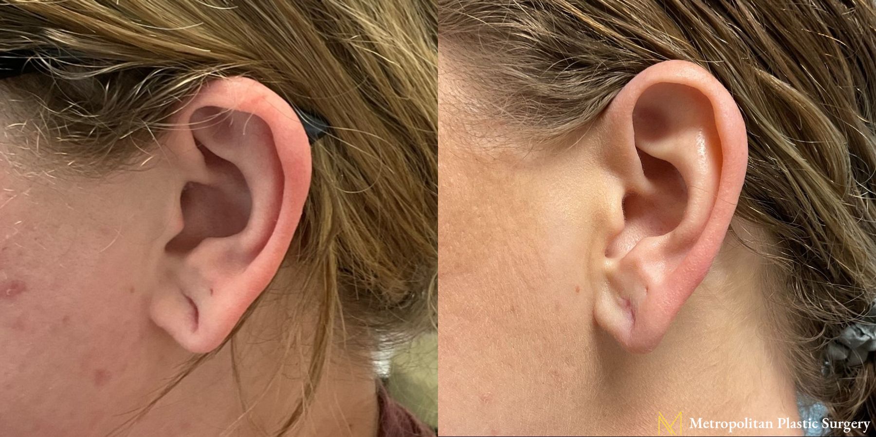 Before and after earlobe repair by Julia Spears MD - Angle 2