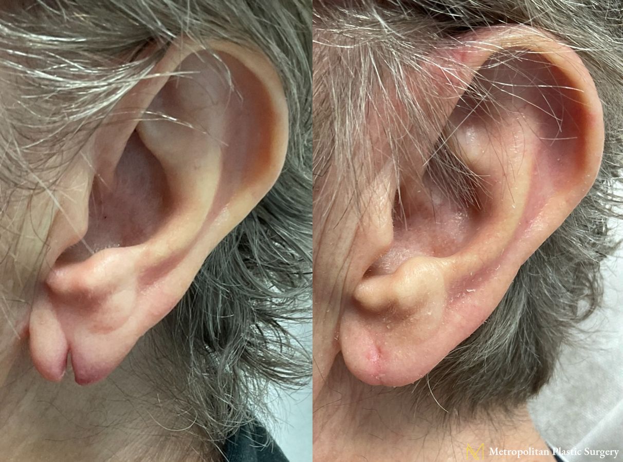 Before and after earlobe repair by Julia Spears MD