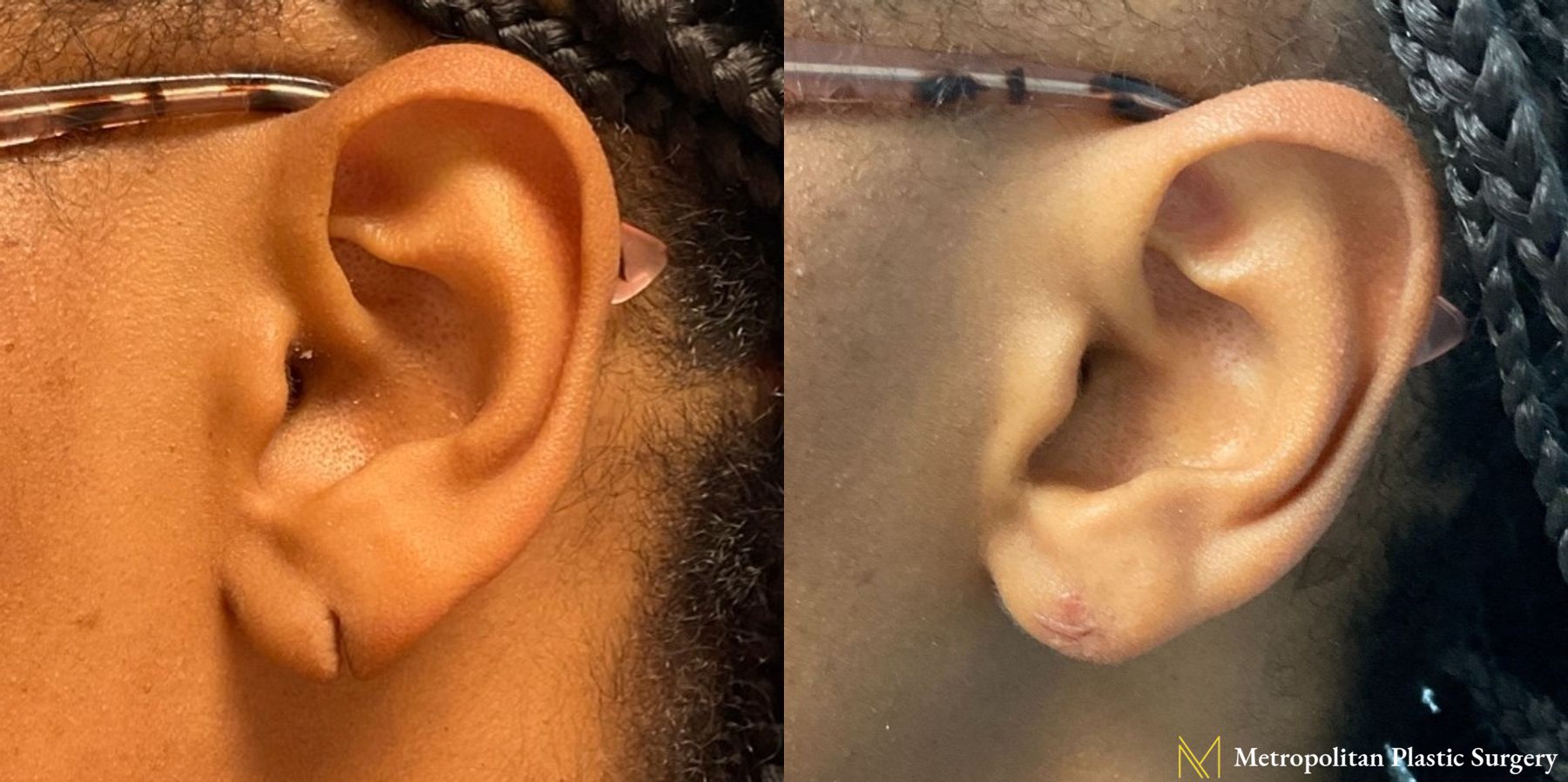 Before and after earlobe repair by Julia Spears MD
