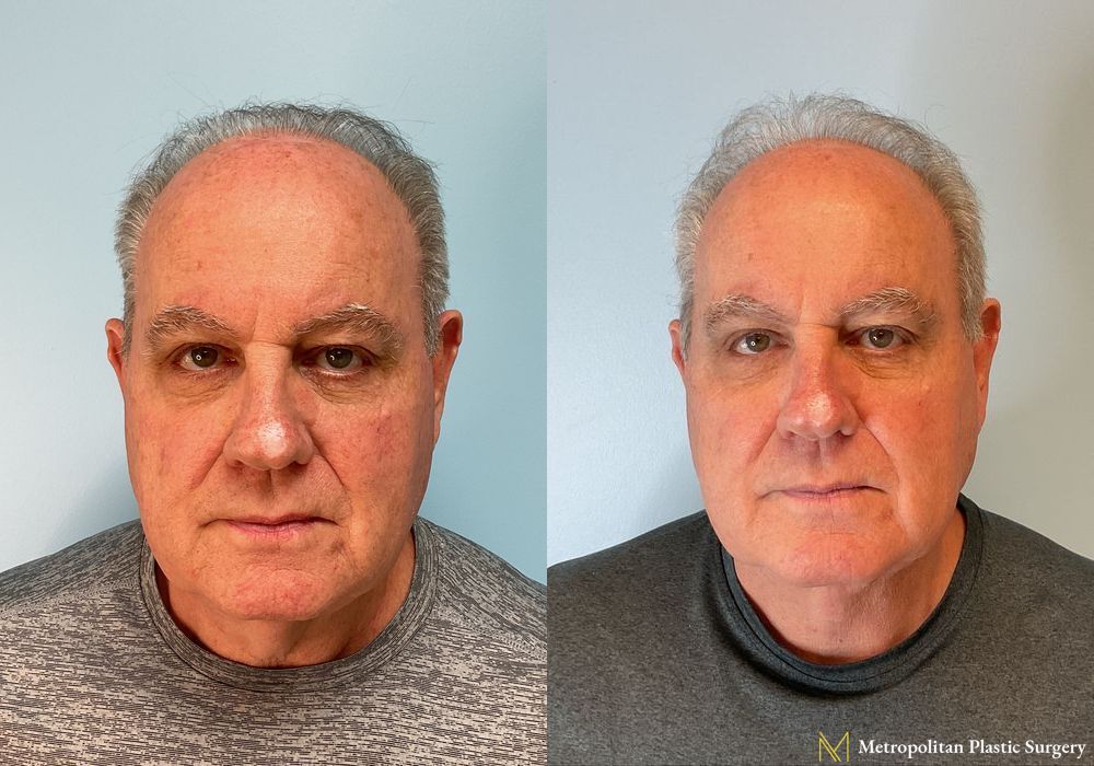 Before and after Facelift & Neck Lift case 16107