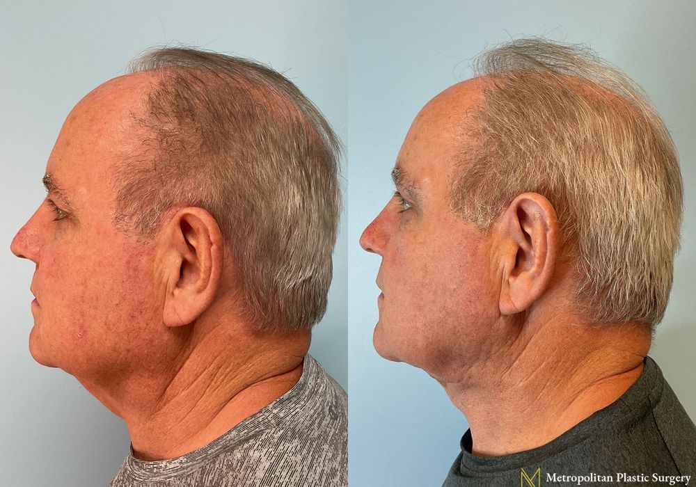 Facelift - Thumbnail 2