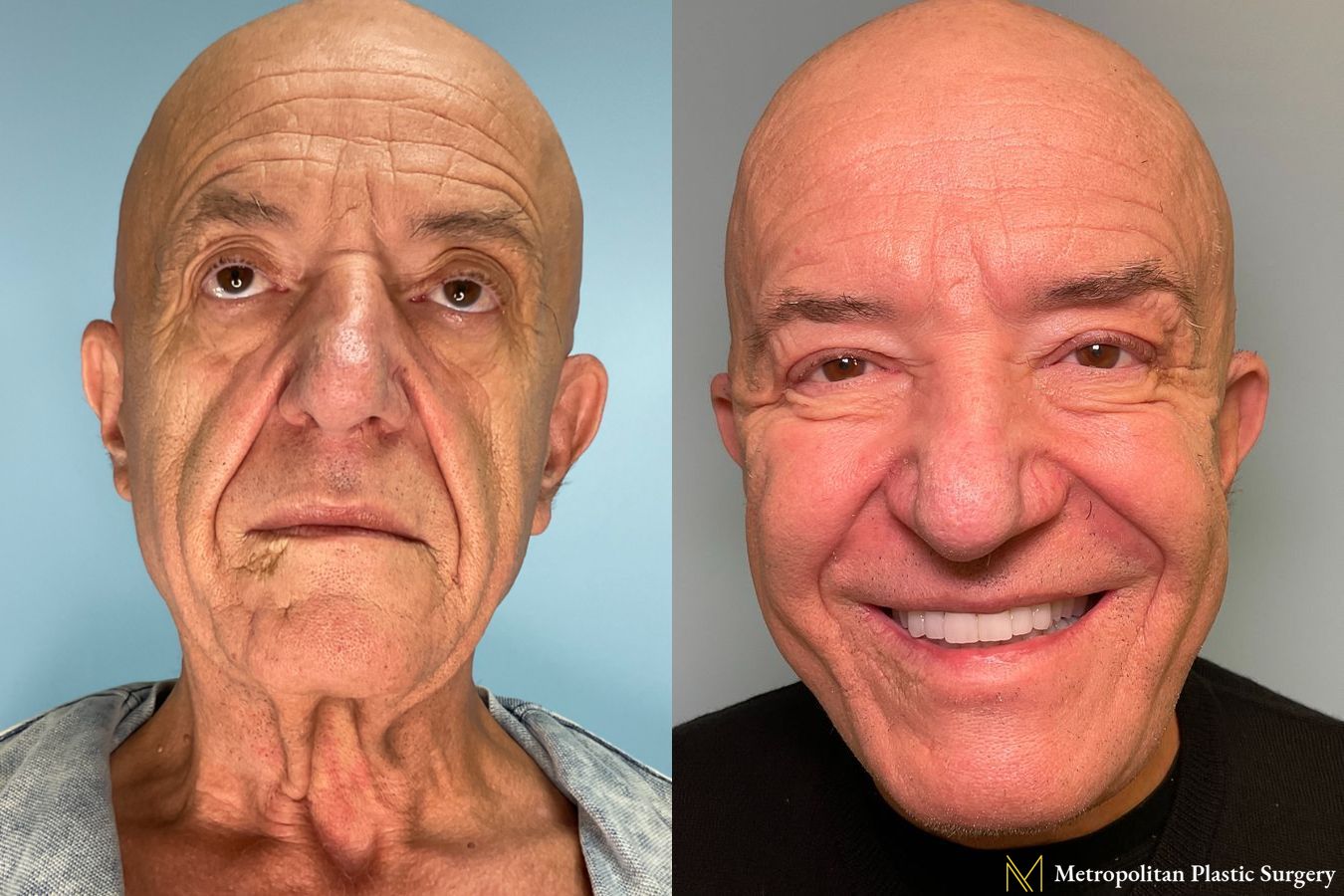 Facelift and Necklift performed by Dr. Julia Spears