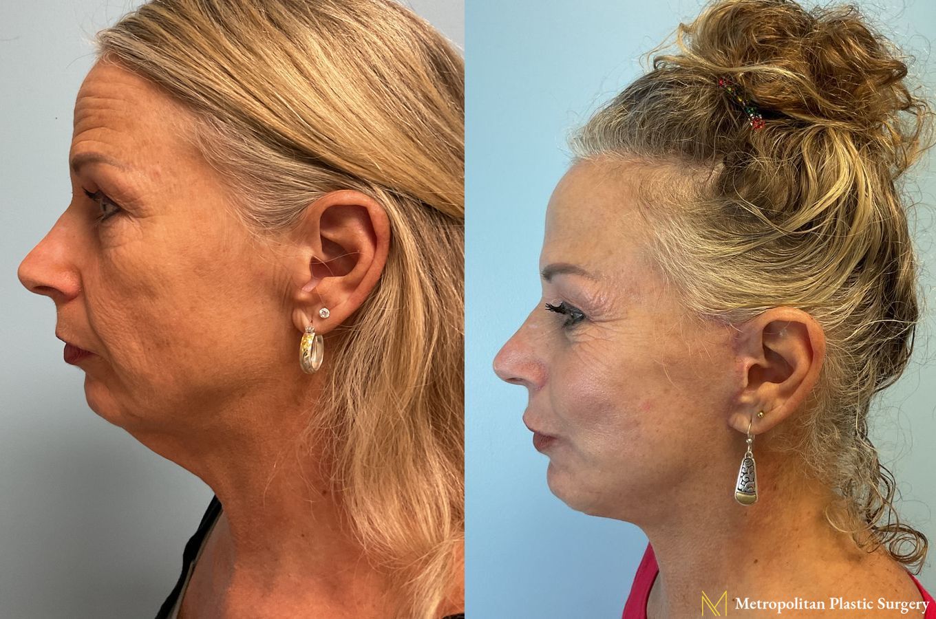 Facelift & Neck Lift with Chin Implant performed by Dr. Julia Spears