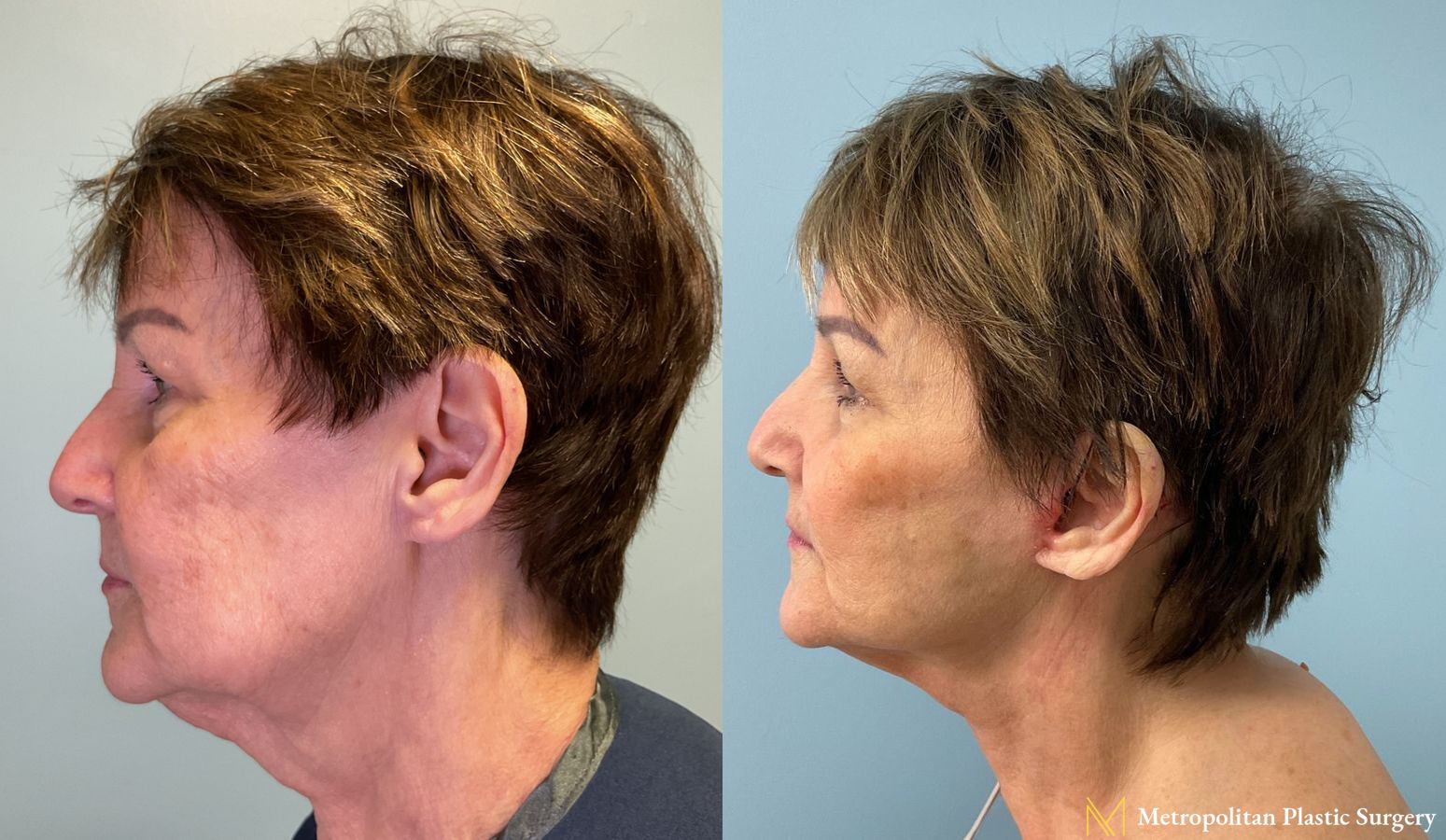 Before and after Facelift & Neck Lift case 23985