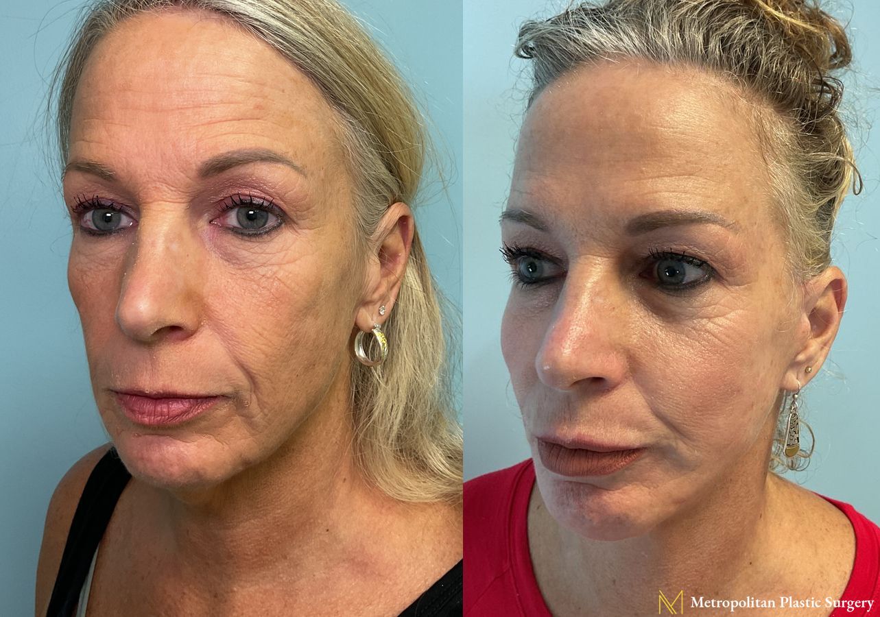 Facelift & Neck Lift with Chin Implant performed by Dr. Julia Spears - Angle 2