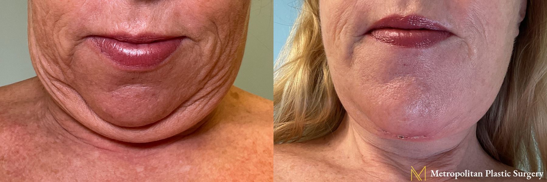 Deep-Plane Face and Necklift with Chin Implant performed by Dr. Julia Spears - Angle 3