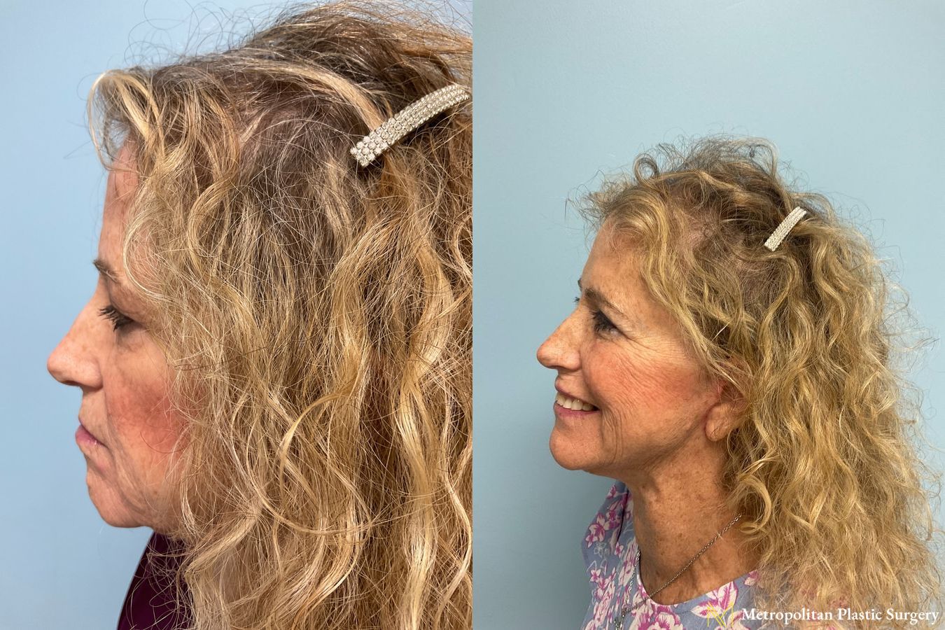 Before and after face lift (rhytidectomy) neck lift from Julia Spears MD - Angle 5