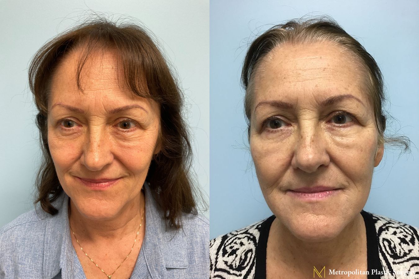 Before and after face lift (rhytidectomy) neck lift from Julia Spears MD
