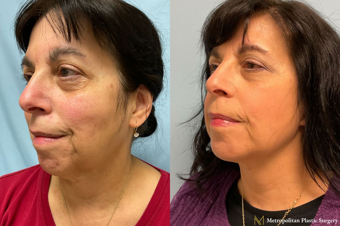 Face and Necklift performed by Dr. Julia Spears - Angle 2