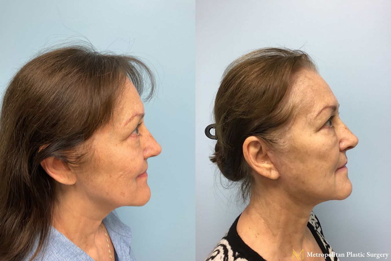 Before and after face lift (rhytidectomy) neck lift from Julia Spears MD - Angle 2