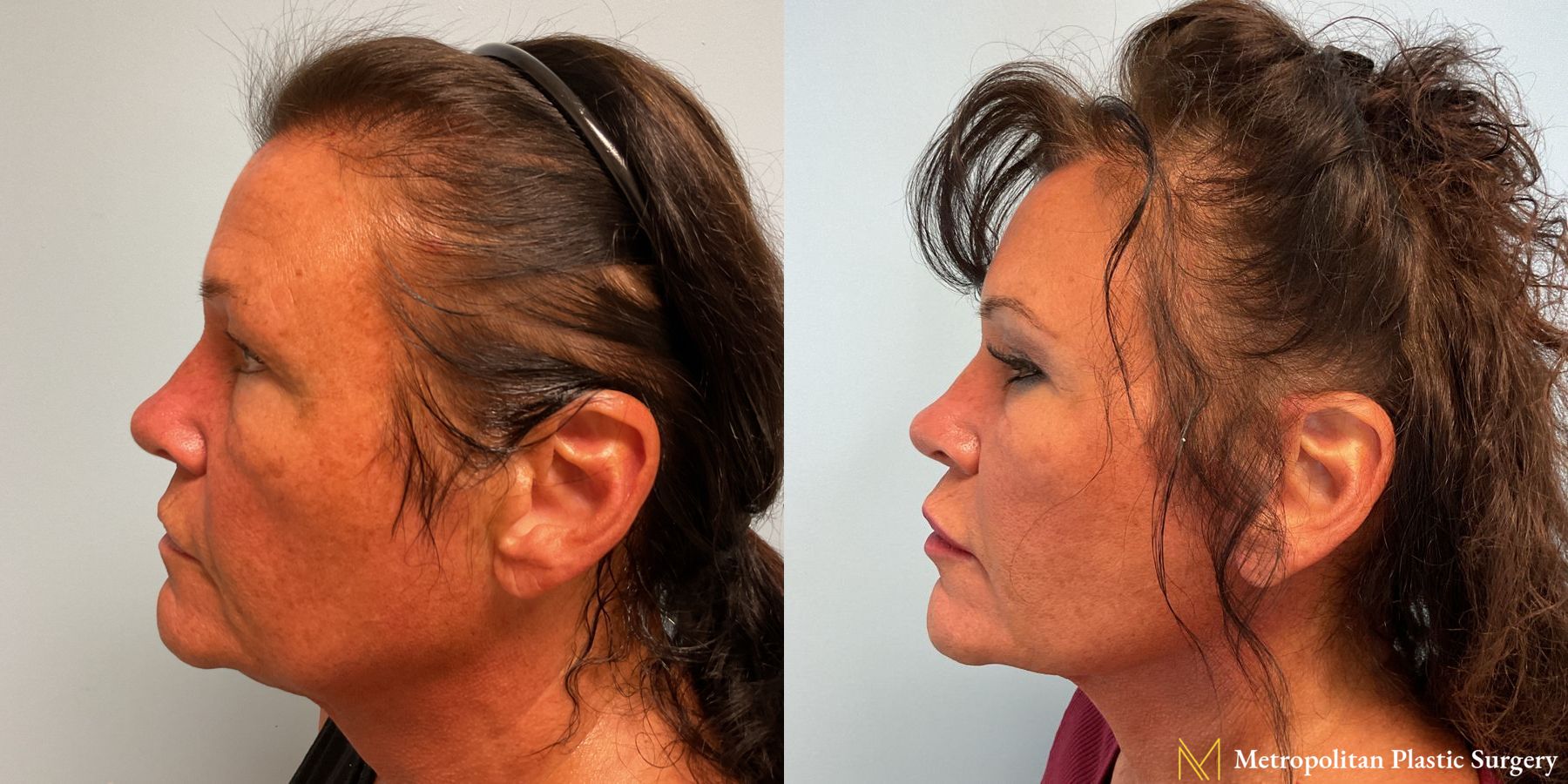 Before and after Facelift & Neck Lift case 23983